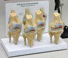 Knee 4-stage Osteoarthr​itis Anatomy Model